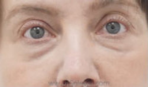 Tear Trough / Under Eye Fillers Before & After Gallery - Patient 333031 - Image 1