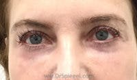 Tear Trough / Under Eye Fillers Before & After Gallery - Patient 333031 - Image 2