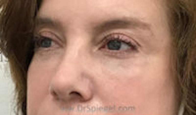 Tear Trough / Under Eye Fillers Before & After Gallery - Patient 333031 - Image 4