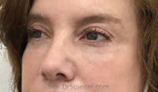 Tear Trough / Under Eye Fillers Before & After Gallery - Patient 333031 - Image 4