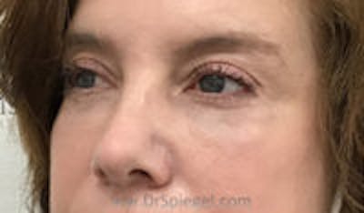 Tear Trough / Under Eye Fillers Before & After Gallery - Patient 333031 - Image 4