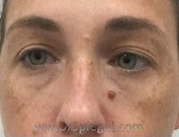 Tear Trough / Under Eye Fillers Before & After Gallery - Patient 419847 - Image 1