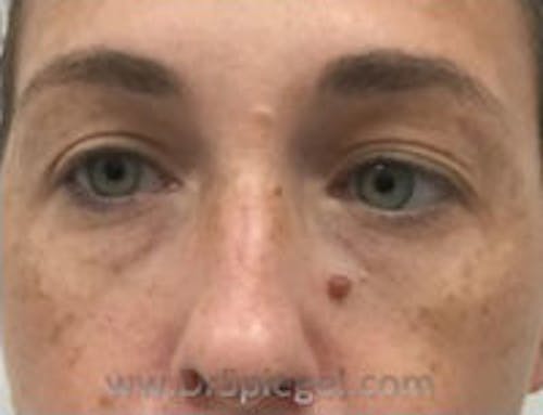 Tear Trough / Under Eye Fillers Before & After Gallery - Patient 419847 - Image 1