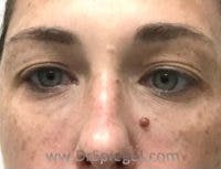 Tear Trough / Under Eye Fillers Before & After Gallery - Patient 419847 - Image 2