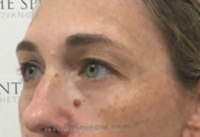 Tear Trough / Under Eye Fillers Before & After Gallery - Patient 419847 - Image 3