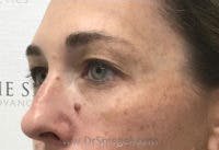 Tear Trough / Under Eye Fillers Before & After Gallery - Patient 419847 - Image 4