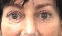 Tear Trough / Under Eye Fillers Before & After Gallery - Patient 347525 - Image 1