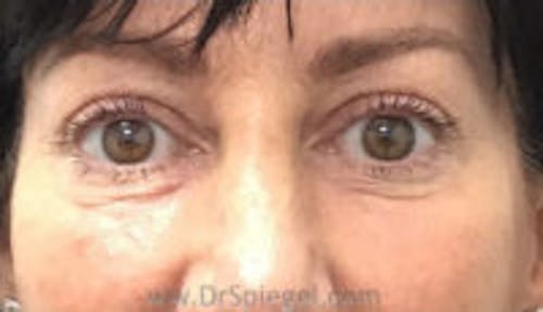 Tear Trough / Under Eye Fillers Before & After Gallery - Patient 347525 - Image 1
