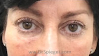 Tear Trough / Under Eye Fillers Before & After Gallery - Patient 347525 - Image 2