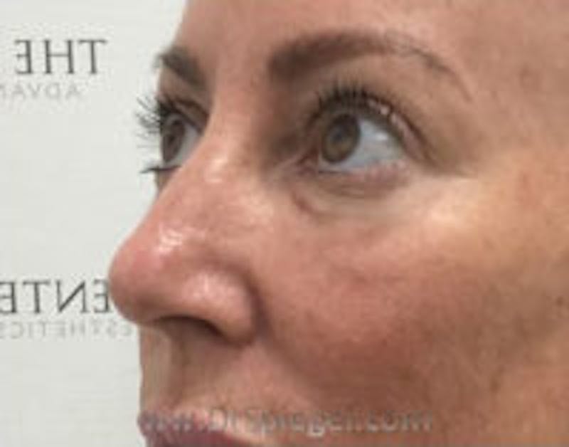 Tear Trough / Under Eye Fillers Before & After Gallery - Patient 347525 - Image 3