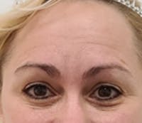 Tear Trough / Under Eye Fillers Before & After Gallery - Patient 248090 - Image 1