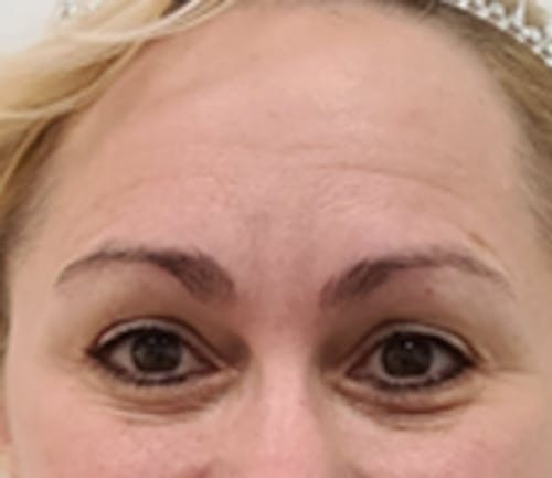 Tear Trough / Under Eye Fillers Before & After Gallery - Patient 248090 - Image 1