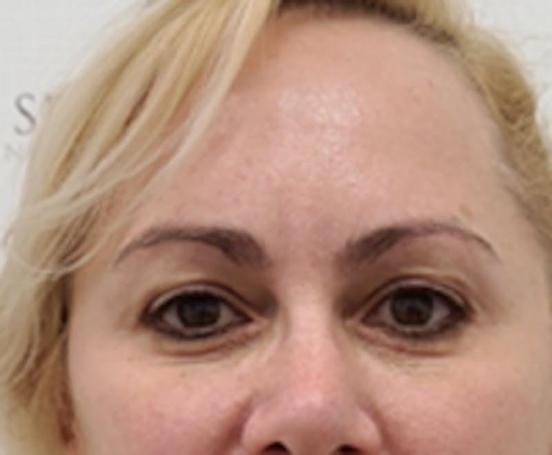 Tear Trough / Under Eye Fillers Before & After Gallery - Patient 248090 - Image 2