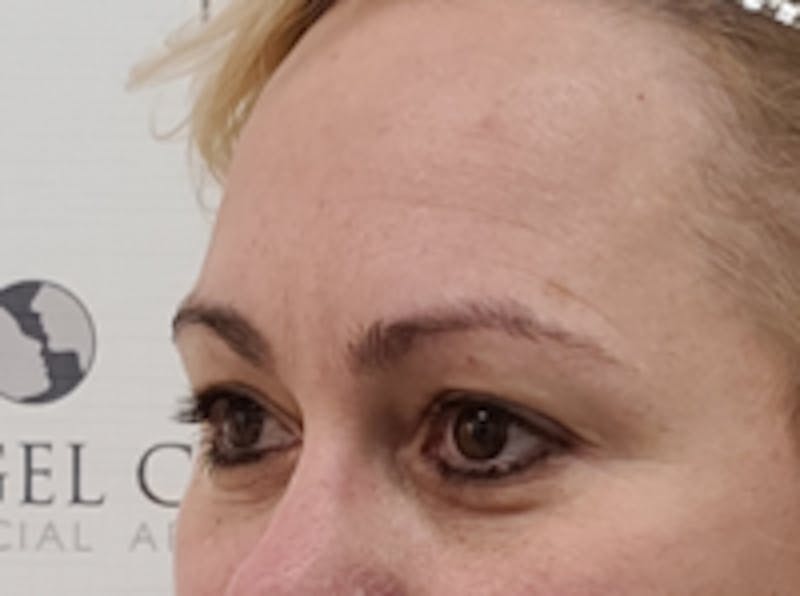 Tear Trough / Under Eye Fillers Before & After Gallery - Patient 248090 - Image 3