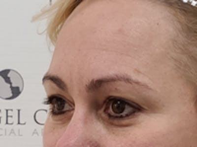 Tear Trough / Under Eye Fillers Before & After Gallery - Patient 248090 - Image 3