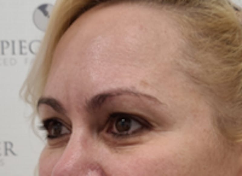 Tear Trough / Under Eye Fillers Before & After Gallery - Patient 248090 - Image 4