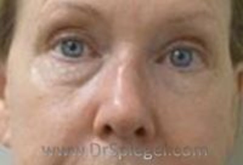 Tear Trough / Under Eye Fillers Before & After Gallery - Patient 349378 - Image 1