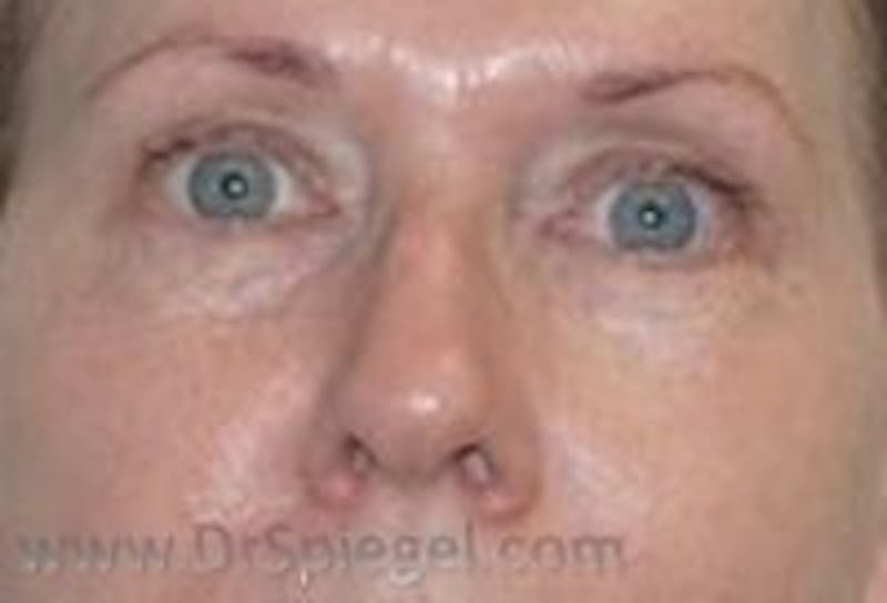 Tear Trough / Under Eye Fillers Before & After Gallery - Patient 349378 - Image 2