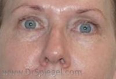 Tear Trough / Under Eye Fillers Before & After Gallery - Patient 349378 - Image 2