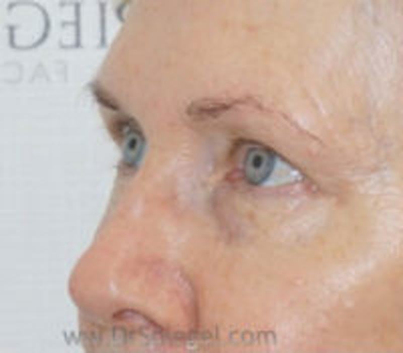 Tear Trough / Under Eye Fillers Before & After Gallery - Patient 349378 - Image 3