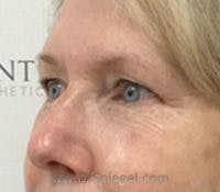 Tear Trough / Under Eye Fillers Before & After Gallery - Patient 349378 - Image 4