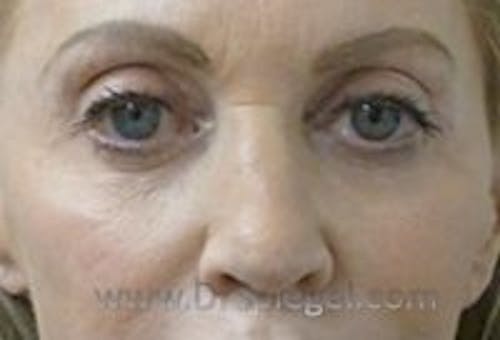 Tear Trough / Under Eye Fillers Before & After Gallery - Patient 290350 - Image 1