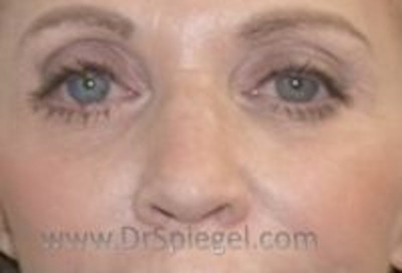 Tear Trough / Under Eye Fillers Before & After Gallery - Patient 290350 - Image 2