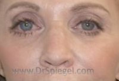 Tear Trough / Under Eye Fillers Before & After Gallery - Patient 290350 - Image 2