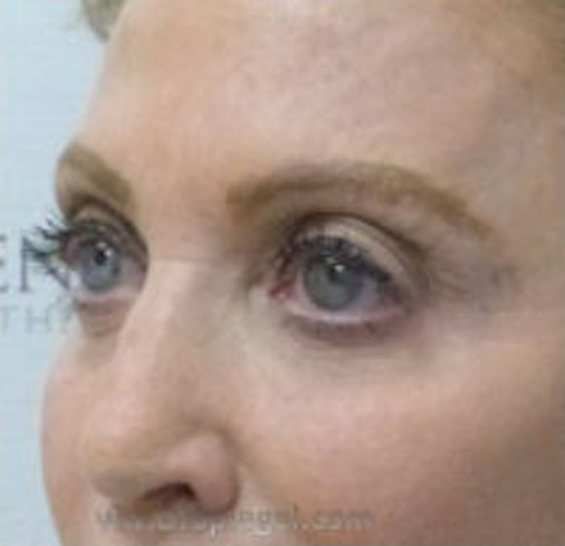 Tear Trough / Under Eye Fillers Before & After Gallery - Patient 290350 - Image 3