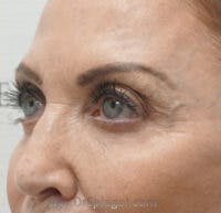 Tear Trough / Under Eye Fillers Before & After Gallery - Patient 290350 - Image 4