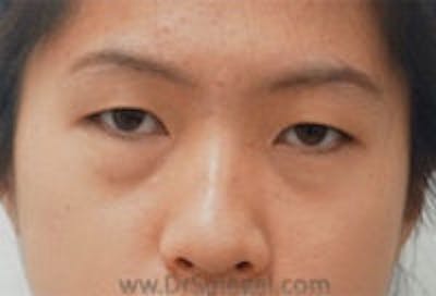Tear Trough / Under Eye Fillers Before & After Gallery - Patient 121377 - Image 1