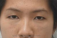 Tear Trough / Under Eye Fillers Before & After Gallery - Patient 121377 - Image 2
