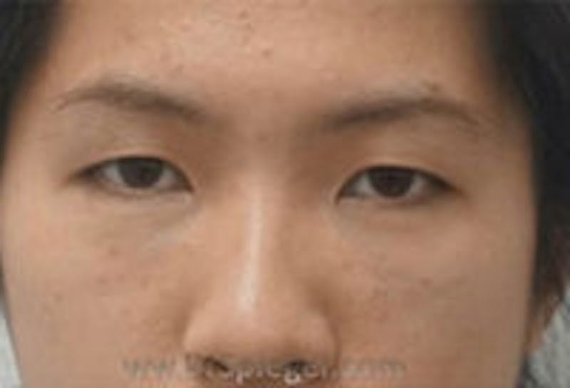 Tear Trough / Under Eye Fillers Before & After Gallery - Patient 121377 - Image 2