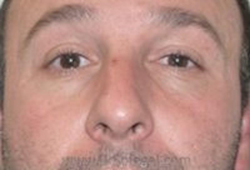 Tear Trough / Under Eye Fillers Before & After Gallery - Patient 273528 - Image 1