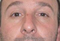 Tear Trough / Under Eye Fillers Before & After Gallery - Patient 273528 - Image 1