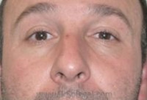 Tear Trough / Under Eye Fillers Before & After Gallery - Patient 273528 - Image 1