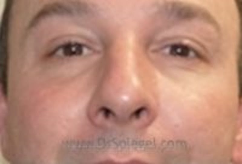 Tear Trough / Under Eye Fillers Before & After Gallery - Patient 273528 - Image 2