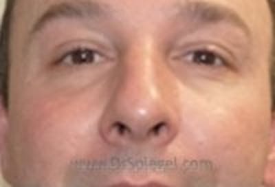 Tear Trough / Under Eye Fillers Before & After Gallery - Patient 273528 - Image 2