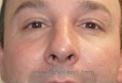 Tear Trough / Under Eye Fillers Before & After Gallery - Patient 273528 - Image 2