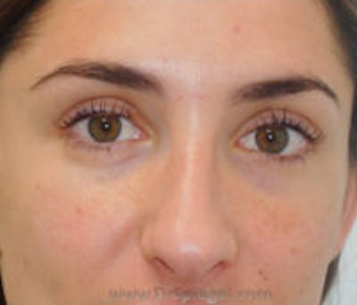 Tear Trough / Under Eye Fillers Before & After Gallery - Patient 307140 - Image 1