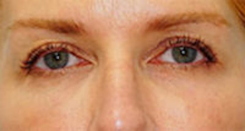 Tear Trough / Under Eye Fillers Before & After Gallery - Patient 310727 - Image 2
