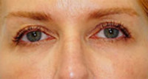 Tear Trough / Under Eye Fillers Before & After Gallery - Patient 310727 - Image 2