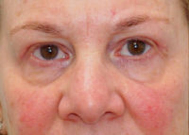 Tear Trough / Under Eye Fillers Before & After Gallery - Patient 371832 - Image 1