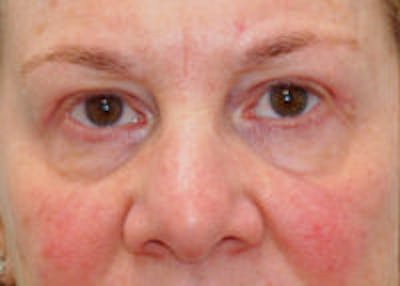 Tear Trough / Under Eye Fillers Before & After Gallery - Patient 371832 - Image 1