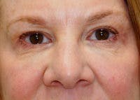 Tear Trough / Under Eye Fillers Before & After Gallery - Patient 371832 - Image 2
