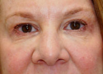 Tear Trough / Under Eye Fillers Before & After Gallery - Patient 371832 - Image 2