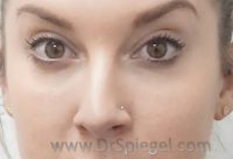 Tear Trough / Under Eye Fillers Before & After Gallery - Patient 137728 - Image 2