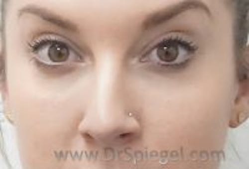 Tear Trough / Under Eye Fillers Before & After Gallery - Patient 137728 - Image 2