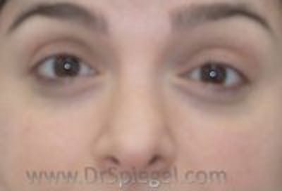 Tear Trough / Under Eye Fillers Before & After Gallery - Patient 221886 - Image 1