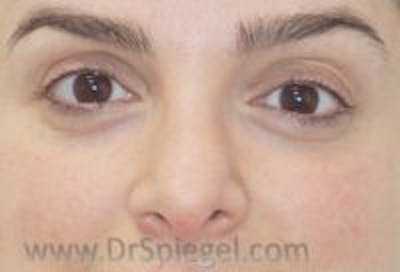 Tear Trough / Under Eye Fillers Before & After Gallery - Patient 221886 - Image 2